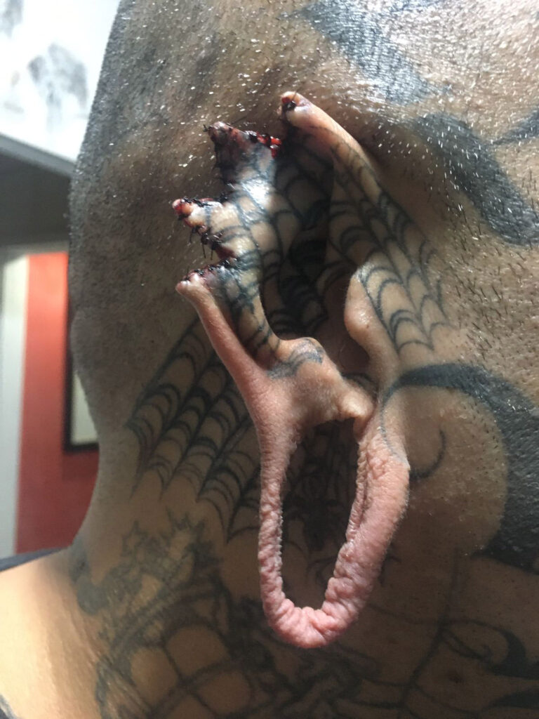 Renato's ear which is cut into the shape of a bat with stitches. 