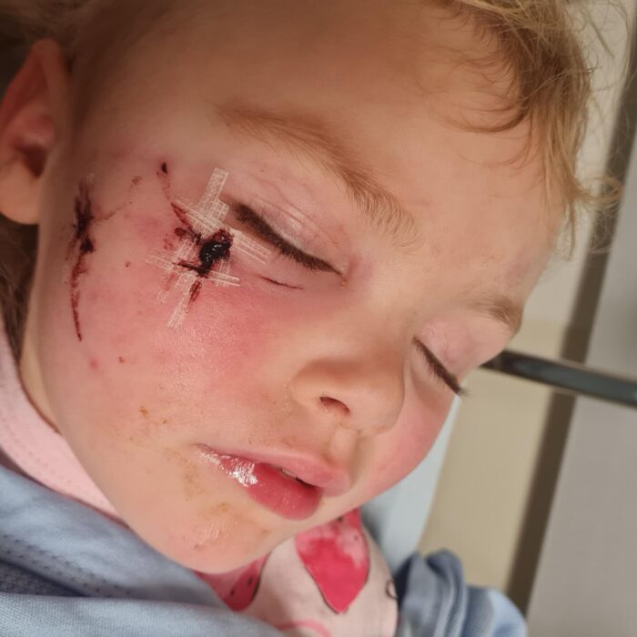 Mum shares horror as daughter, 3, viciously attacked by dog – leaving her ‘black and blue’