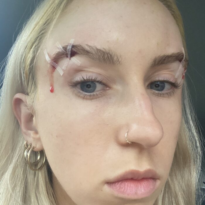 TikToker, 25, left in ‘excruciating pain’ after botched FOX EYE LIFT goes viral warning others – ‘don’t do it’