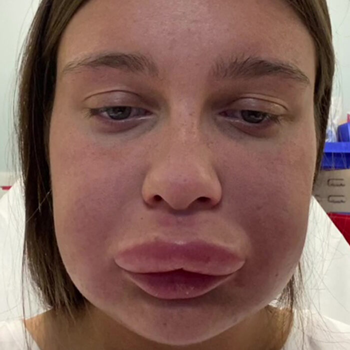 ‘I got my lip fillers dissolved and ended up in hospital,’ says woman, 23, going viral after being compared to DONALD DUCK