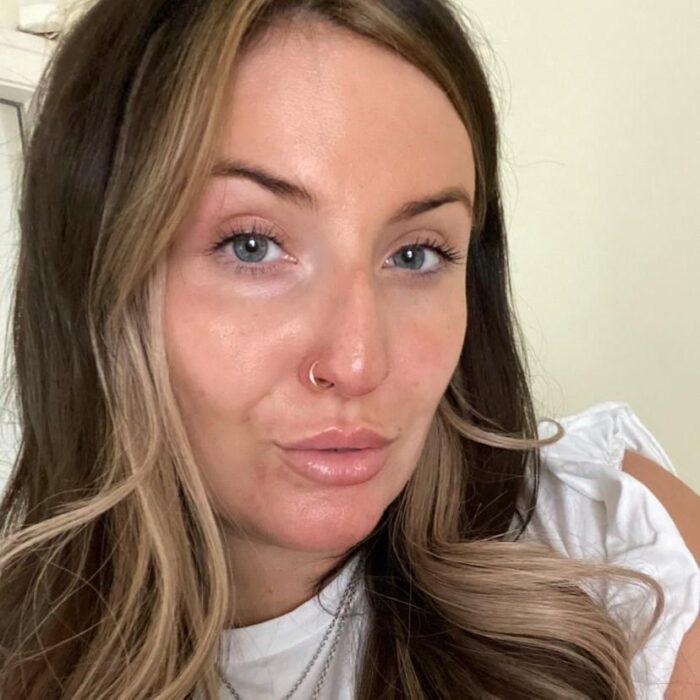 Woman battling ‘horrific acne’ and ‘afraid to go food shopping due to people staring’ clears it up in two weeks – with FAKE TAN